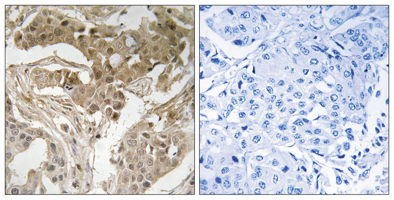 Immunohistochemical analysis of paraffin-embedded human breast carcinoma tissue using FOS (Phospho-Thr232) antibody (left) or the same antibody preincubated with blocking peptide (right) .