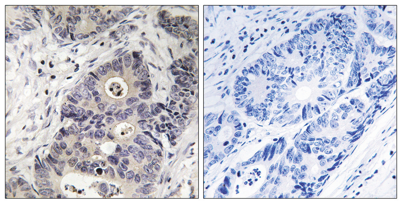 Immunohistochemical analysis of paraffin-embedded human colon carcinoma tissue using Inos (Phospho-Tyr151) antibody (left) or the same antibody preincubated with blocking peptide (right) .