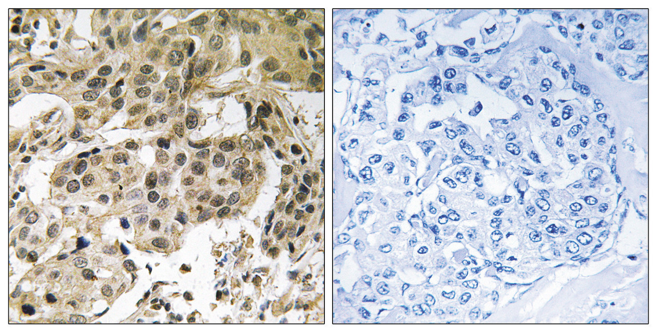 Immunohistochemical analysis of paraffin-embedded human breast carcinoma tissue using HP1alpha (Phospho-Ser92) antibody (left) or the same antibody preincubated with blocking peptide (right) .