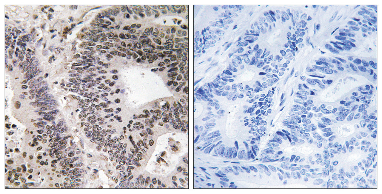 Immunohistochemical analysis of paraffin-embedded human colon carcinoma tissue using WWOX (Phospho-Tyr33) antibody (left) or the same antibody preincubated with blocking peptide (right) .