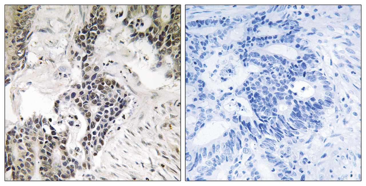 Immunohistochemical analysis of paraffin-embedded human colon carcinoma tissue using CDC25C (Phospho-Ser198) antibody (left) or the same antibody preincubated with blocking peptide (right) .
