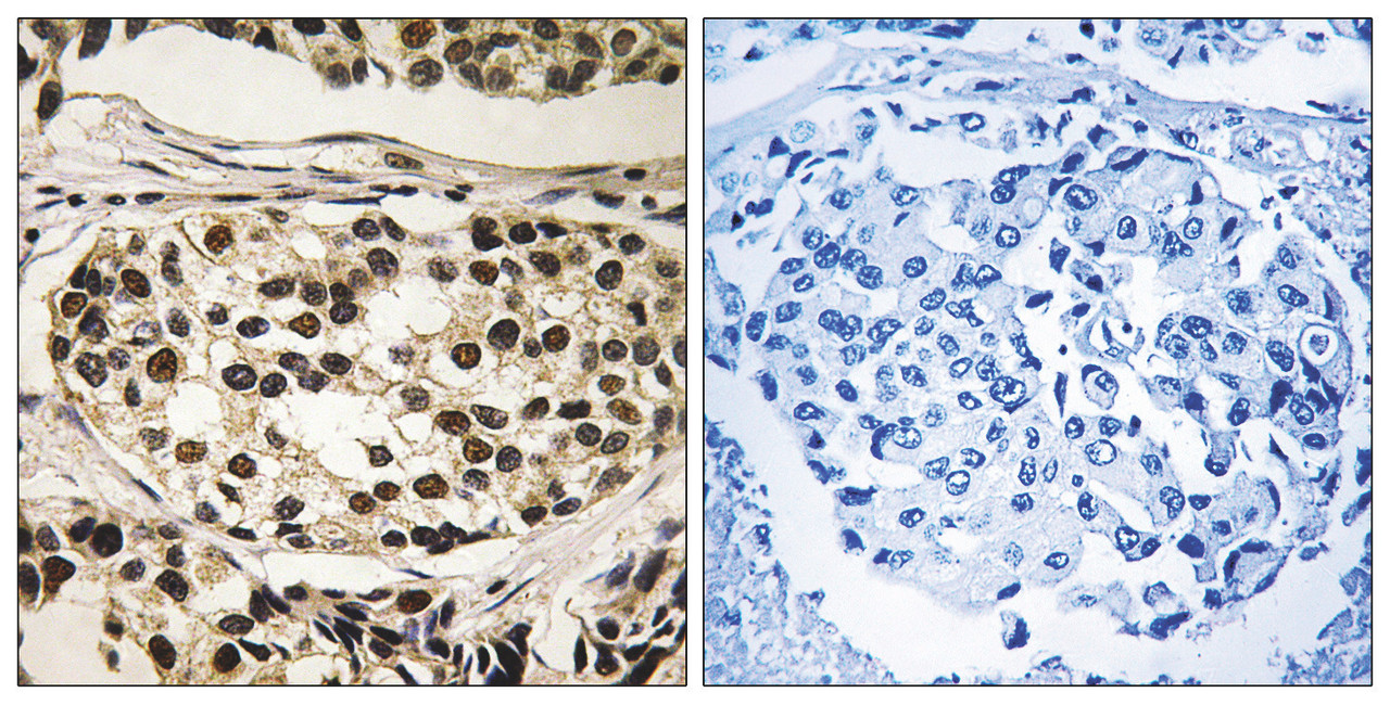 Immunohistochemical analysis of paraffin-embedded human breast carcinoma tissue using Cyclin C (Phospho-Ser275) antibody (left) or the same antibody preincubated with blocking peptide (right) .