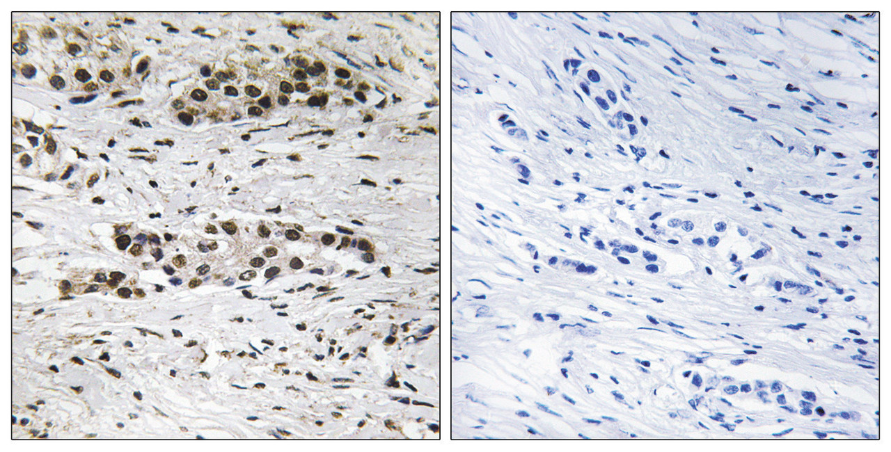 Immunohistochemical analysis of paraffin-embedded human breast carcinoma tissue using Estrogen Receptor-alpha (Phospho-Ser102) antibody (left) or the same antibody preincubated with blocking peptide (right) .
