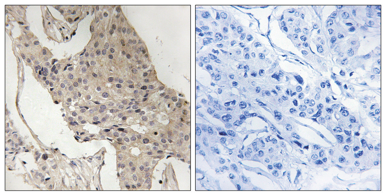 Immunohistochemical analysis of paraffin-embedded human breast carcinoma tissue using Gab2 (Phospho-Ser623) antibody (left) or the same antibody preincubated with blocking peptide (right) .