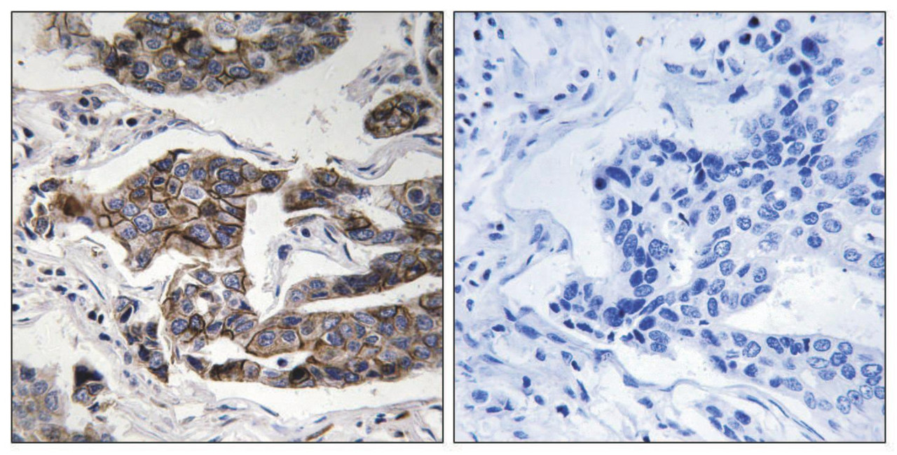 Immunohistochemical analysis of paraffin-embedded human breast carcinoma tissue using Girdin (Phospho-Ser1417) antibody (left) or the same antibody preincubated with blocking peptide (right) .