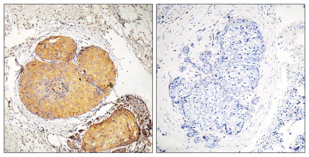 Immunohistochemical analysis of paraffin-embedded human breast carcinoma tissue, using FADD (Phospho-Ser191) antibody (left) or the same antibody preincubated with blocking peptide (right) .
