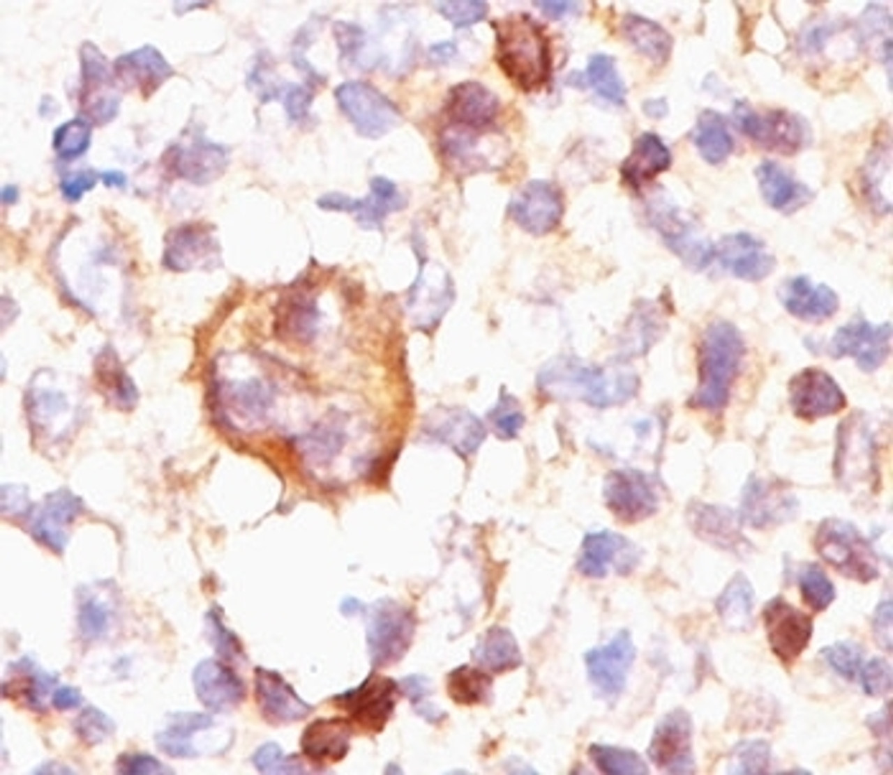 IHC testing of Hodgkin's lymphoma stained with Bcl-X antibody (BX006) . Note cytoplasmic and membrane staining.