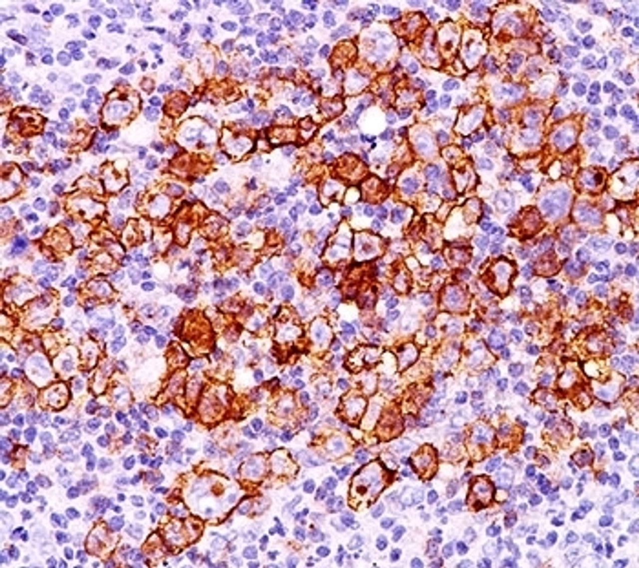 IHC testing of Hodgkin's lymphoma (20X) stained with CD30 antibody (CD30/412) .