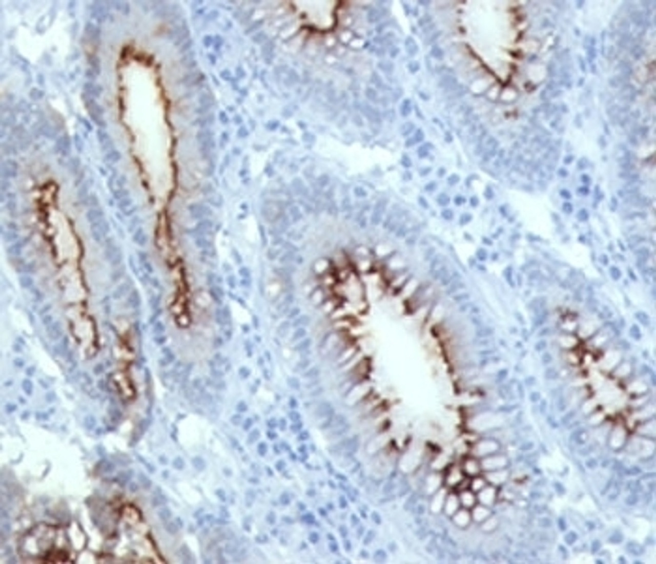 IHC testing of human colon carcinoma stained with CEA antibody (C66/261) .