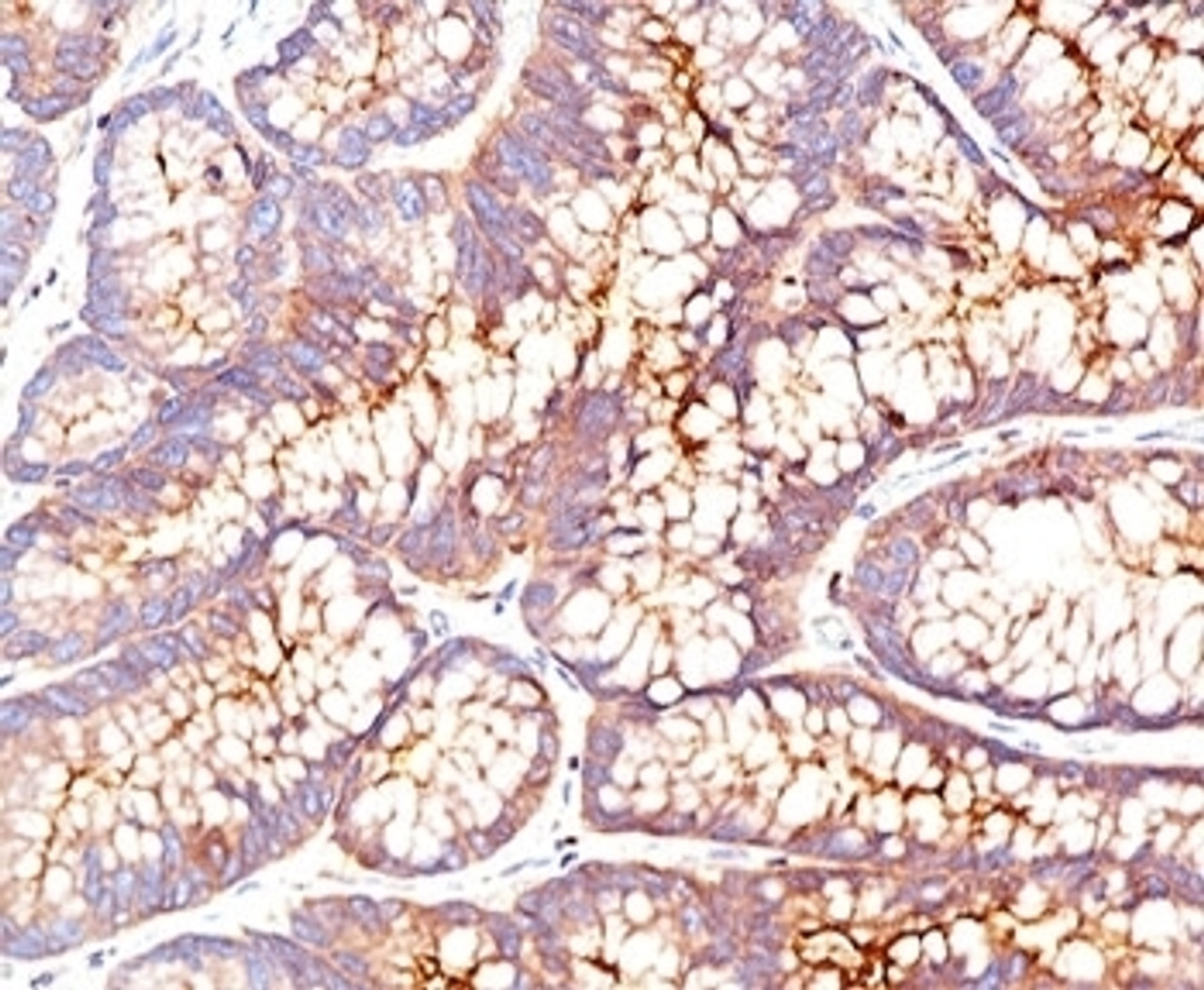 IHC testing of human colon carcinoma stained with CEA antibody (CEA31) .