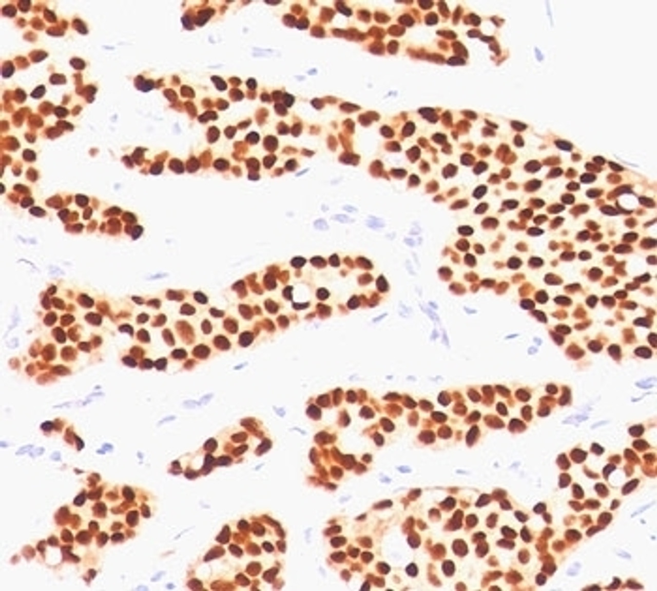 IHC testing of human breast invasive carcinoma stained with Estrogen receptor antibody (ER505) .