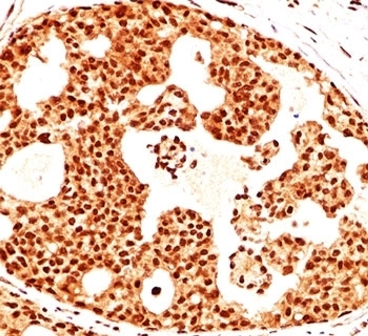 IHC testing of breast cancer stained with Estrogen Receptor beta antibody (ERb455) .