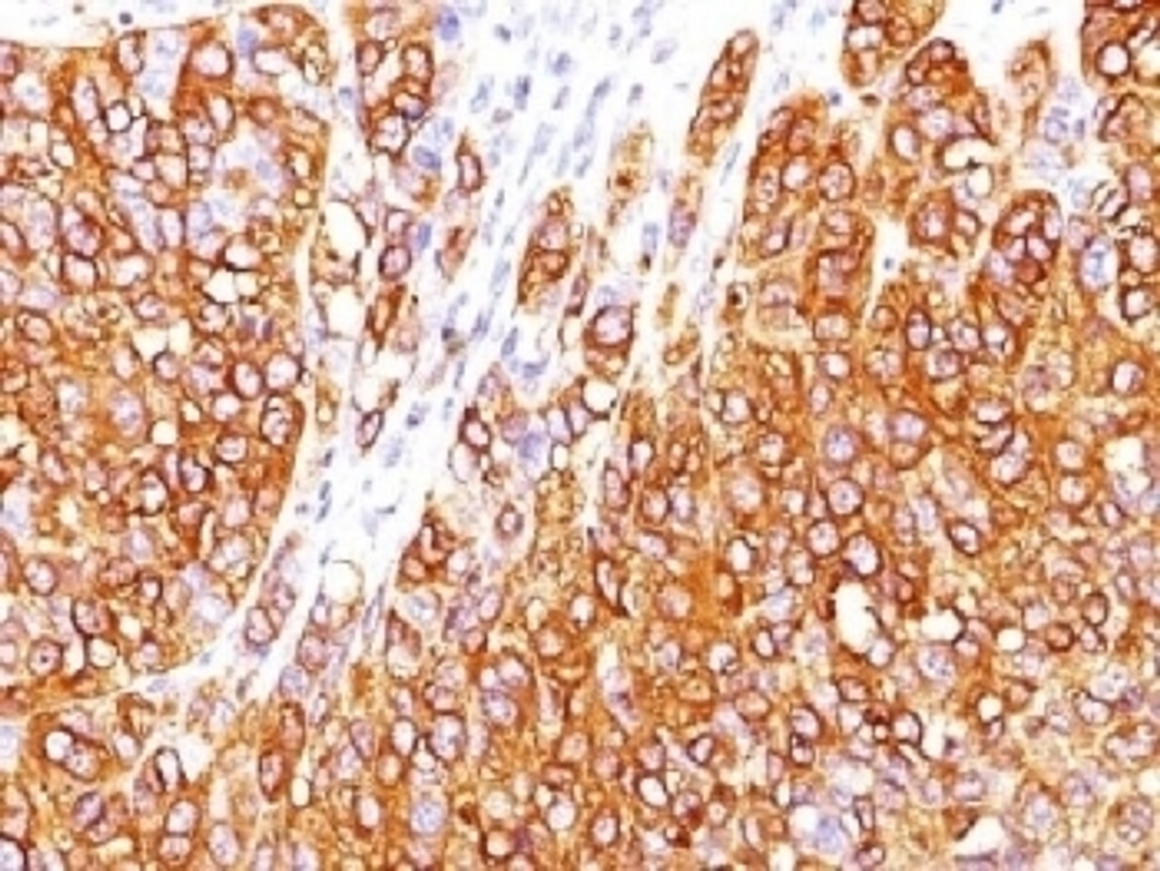 IHC testing of human melanoma stained with MART-1 antibody (M2-7C10) . Note cytoplasmic staining of cells.