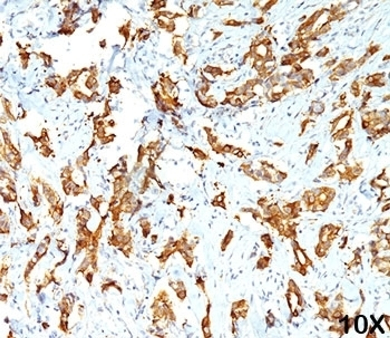 IHC testing of human breast carcinoma (10X) stained with HSP27 antibody (G3.1) .