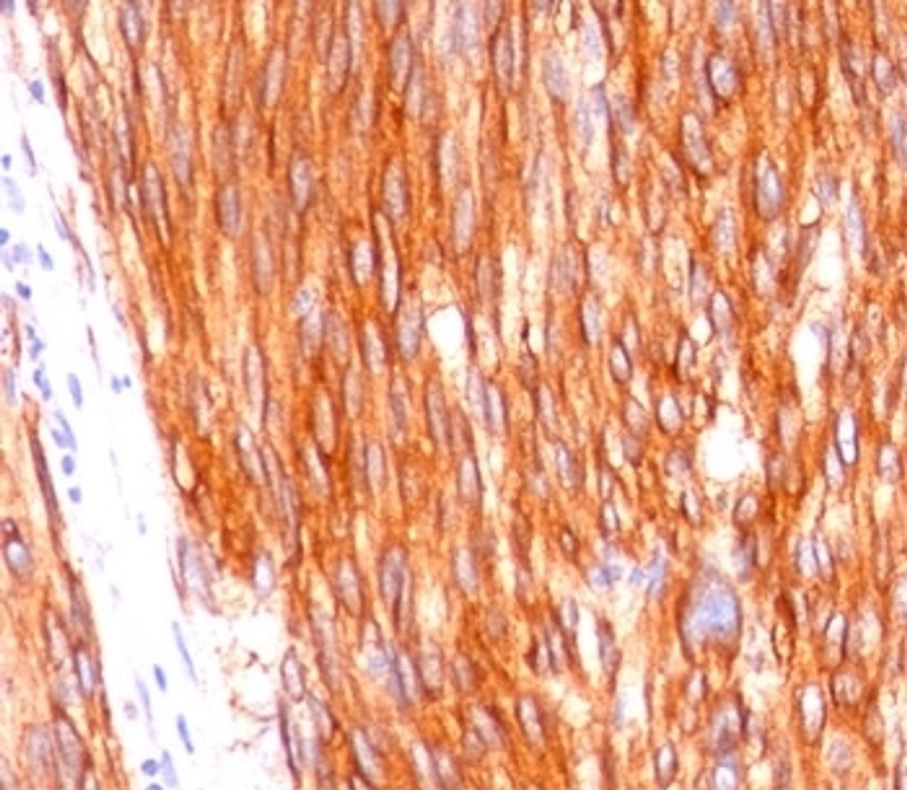Formalin-paraffin human gastrointestinal stromal tumor (GIST) stained with CD117 antibody (C117/370) .