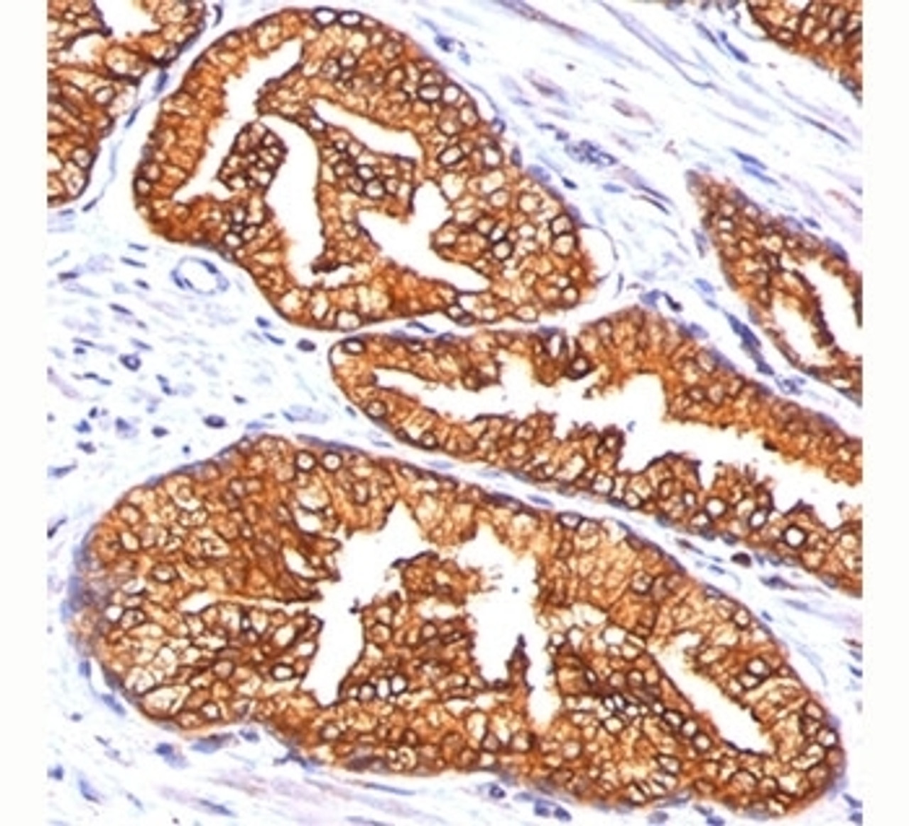 Formalin/paraffin human prostate carcinoma stained with ODC-1 antibody.