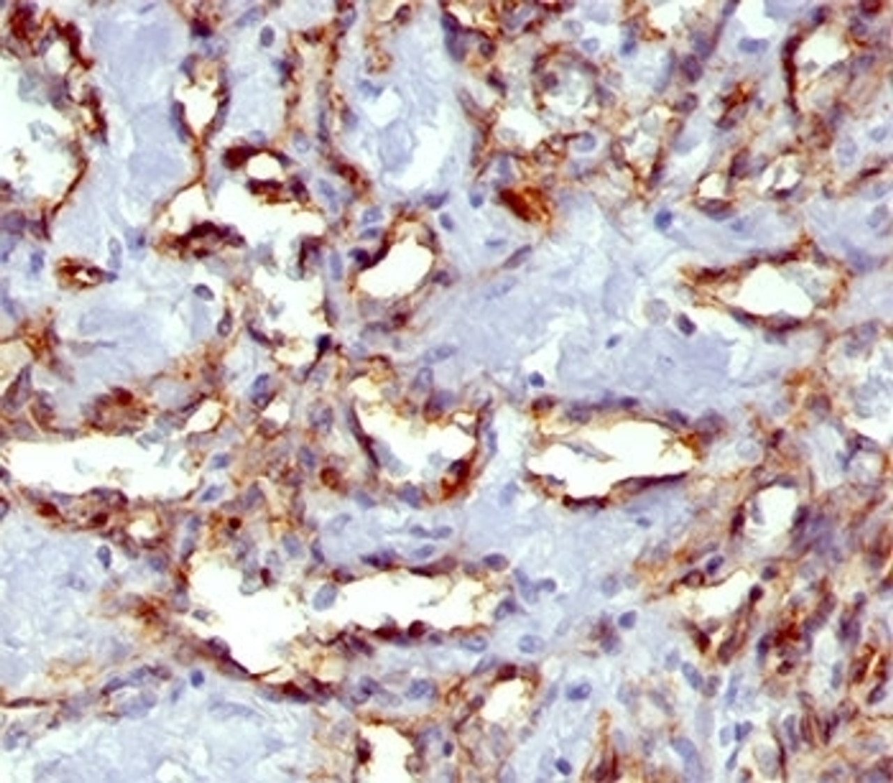IHC staining of angiosarcoma with PECAM-1 antibody (C31.7) .