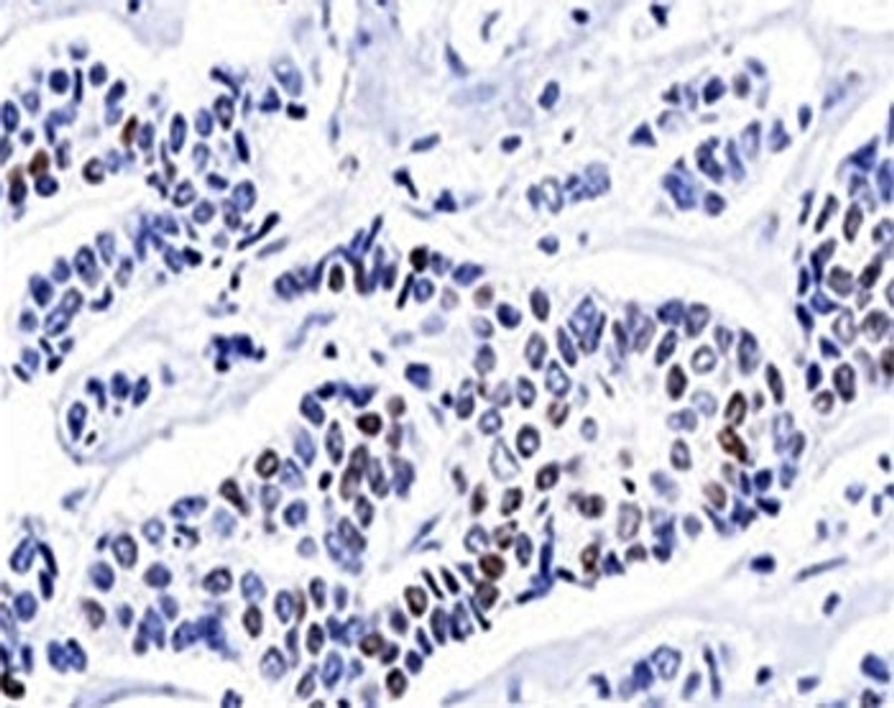 IHC testing of invasive ductal carcinoma stained with progesterone receptor antibody (PR501) .