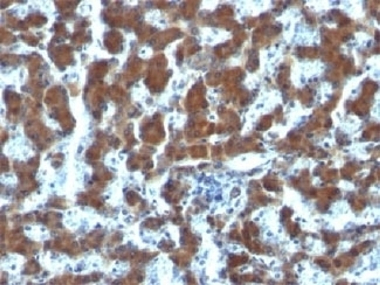 IHC testing of FFPE human hepatocellular carcinoma and RBP antibody (clone G4E4) .
