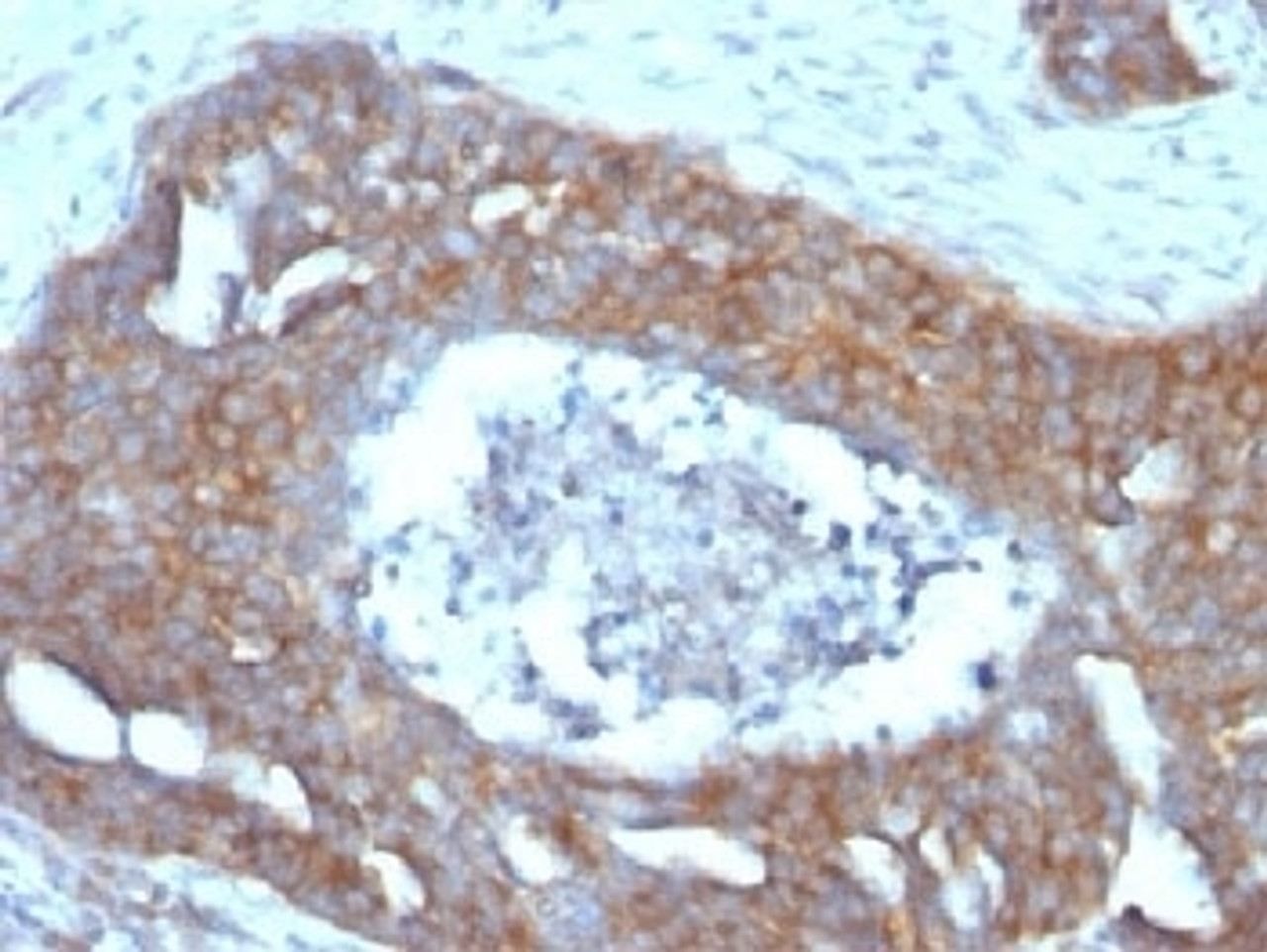 IHC testing of FFPE human ovarian carcinoma with Estrogen Inducible Protein pS2 antibody