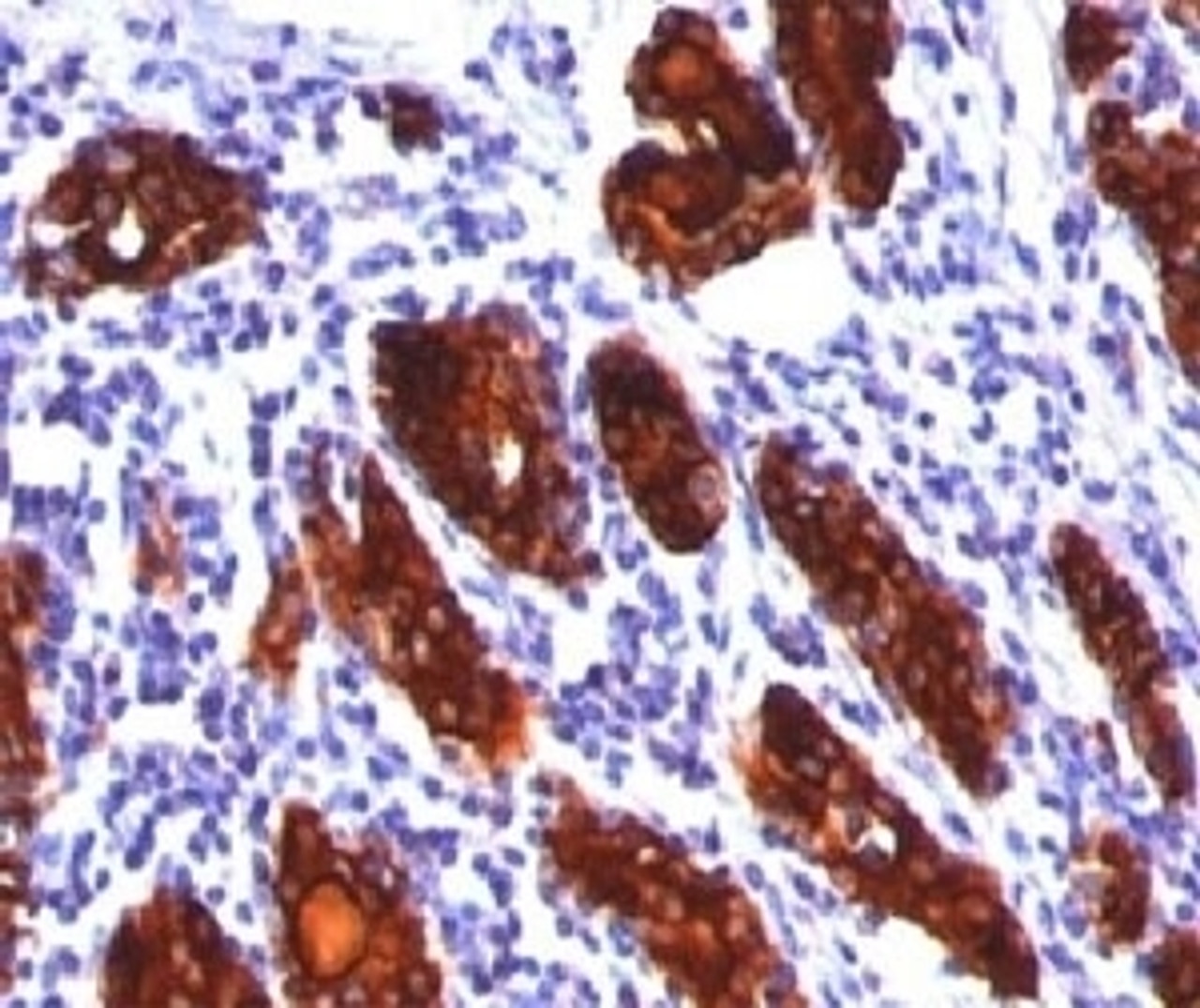 IHC staining of thyroid tissue with Thyroglobulin antibody (2H11, aka clone TBG04) .