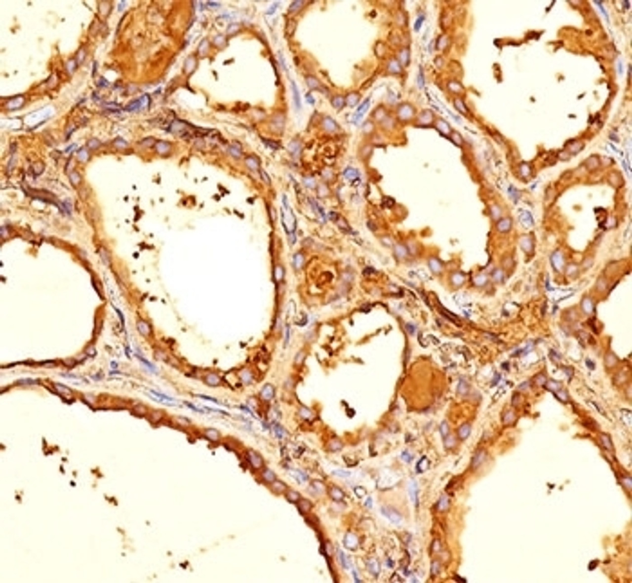 IHC staining of human thyroid tissue with Thyroglobulin antibody (6E1, aka clone TGB05) .
