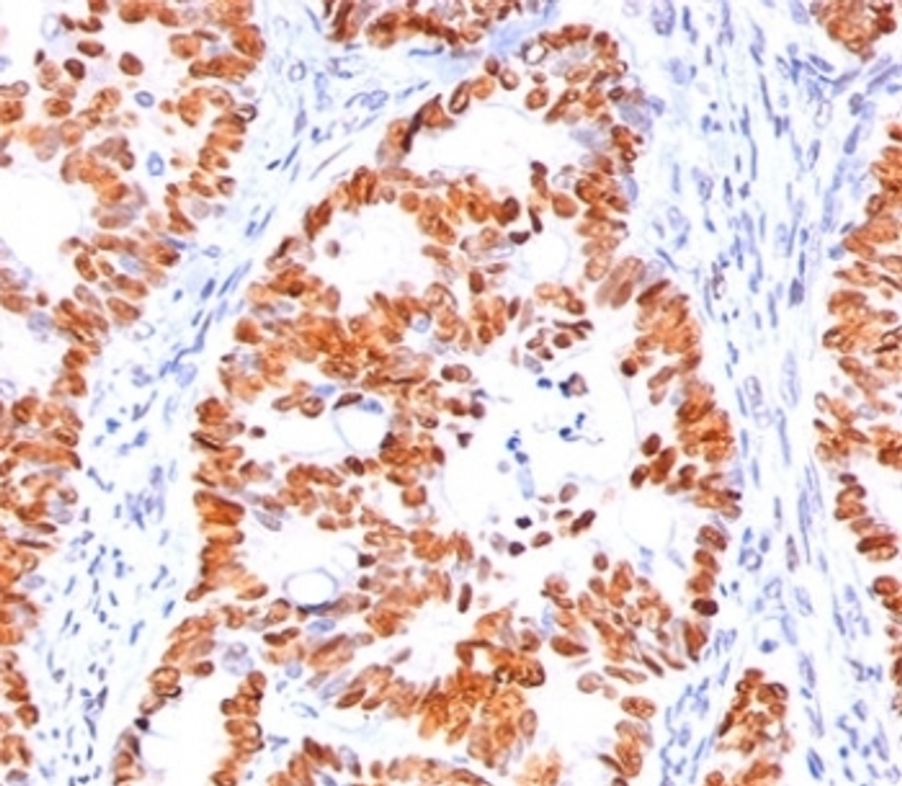 IHC staining of human colon carcinoma with p53 antibody (BP53-12) .