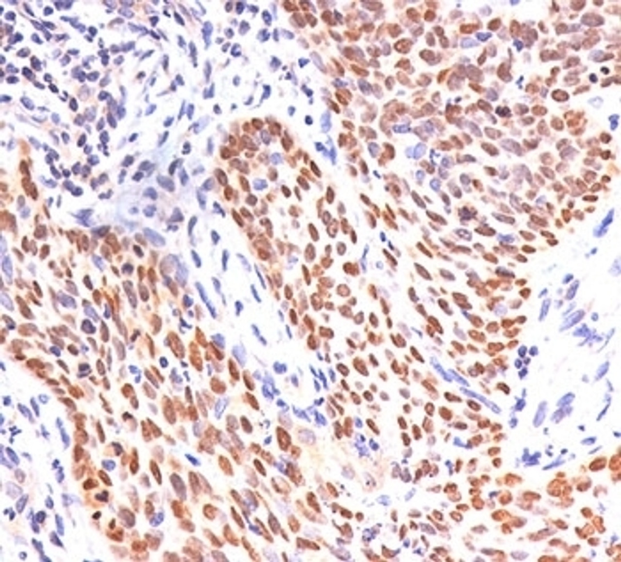 IHC staining of lung squamous cell carcinoma with p40 antibody.