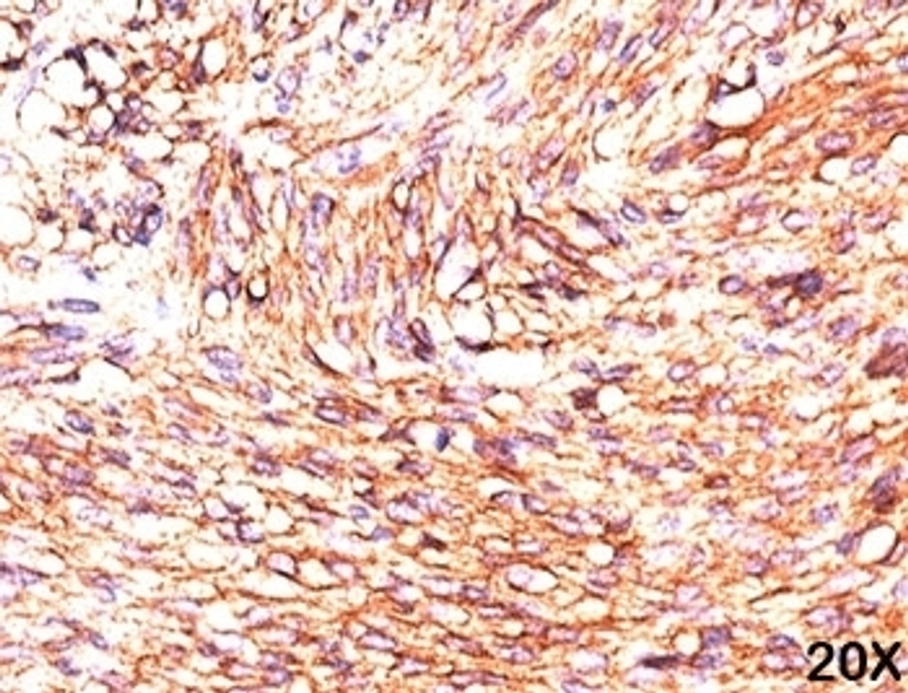 Formalin/paraffin human gastrointestinal stromal tumor (20X) stained with TMEM16A antibody (DG1/447) .