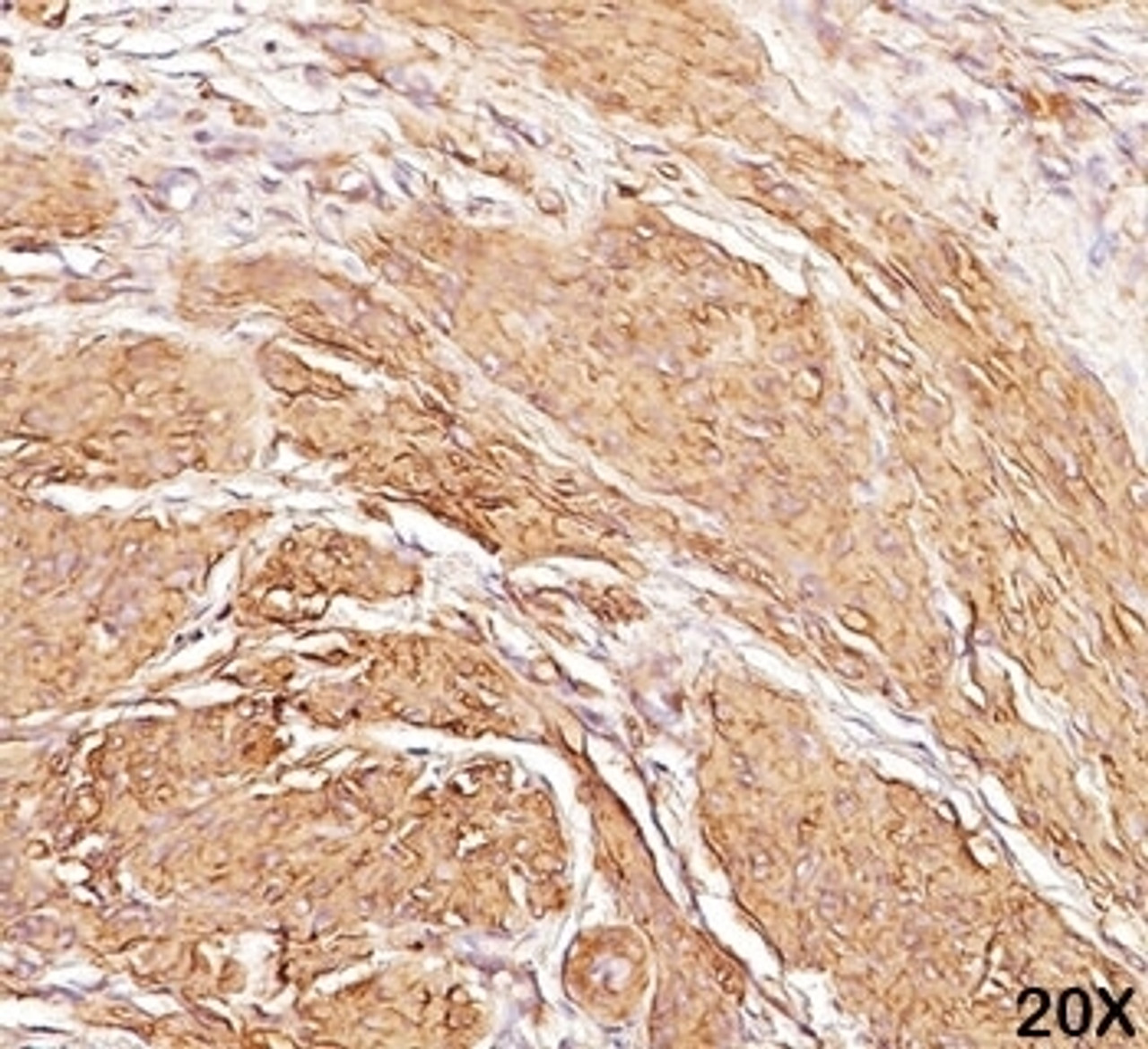 IHC staining of human leiomyosarcoma (20X) with Muscle actin antibody (HHF35) .
