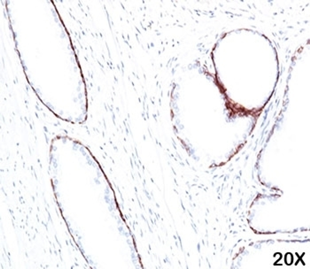IHC staining of human prostate (20X) with HMW Cytokeratin antibody (34bE12) .