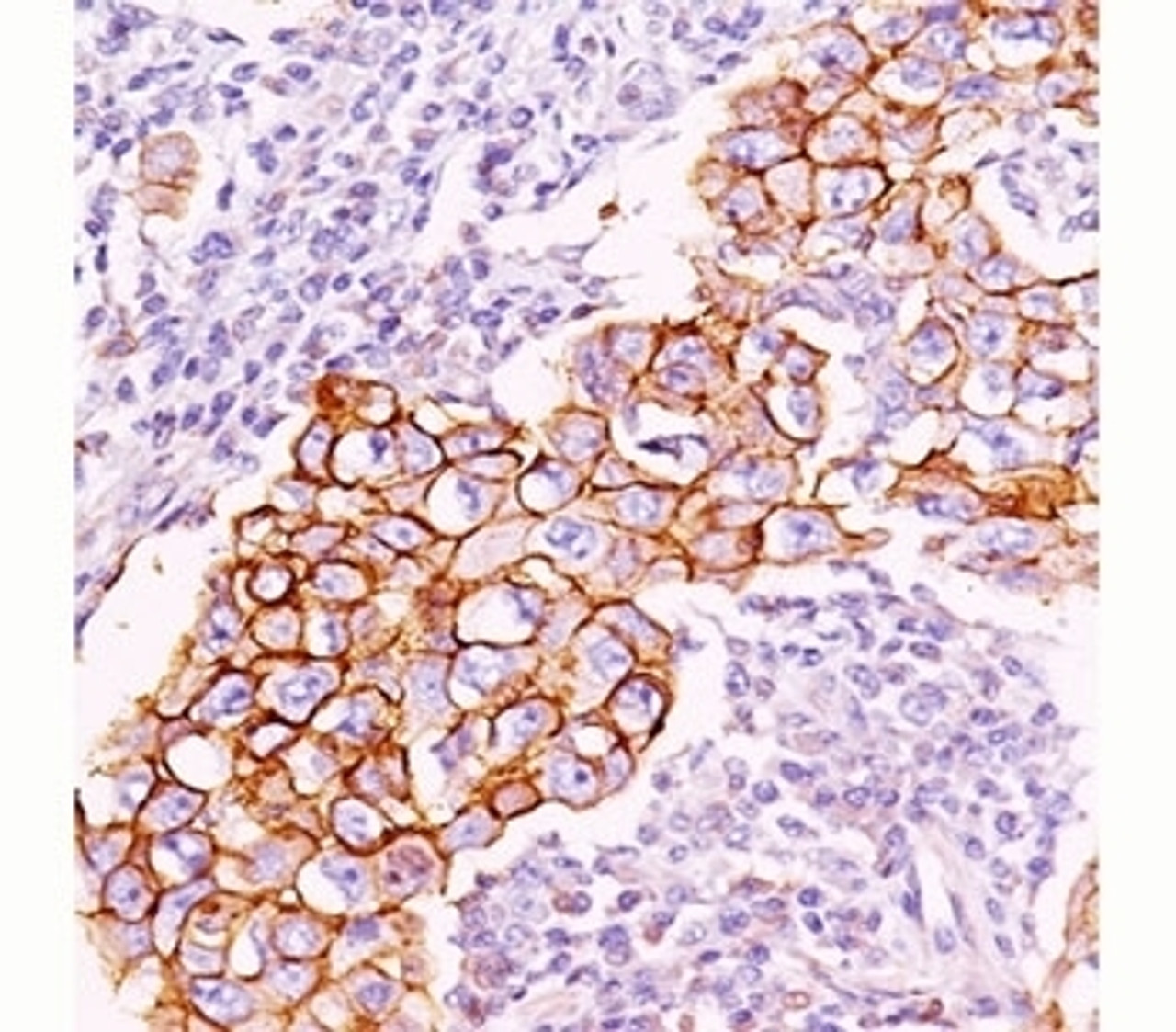 IHC staining of breast carcinoma with phosphotyrosine antibody (PY20) . Note cell surface and cytoplasmic staining.