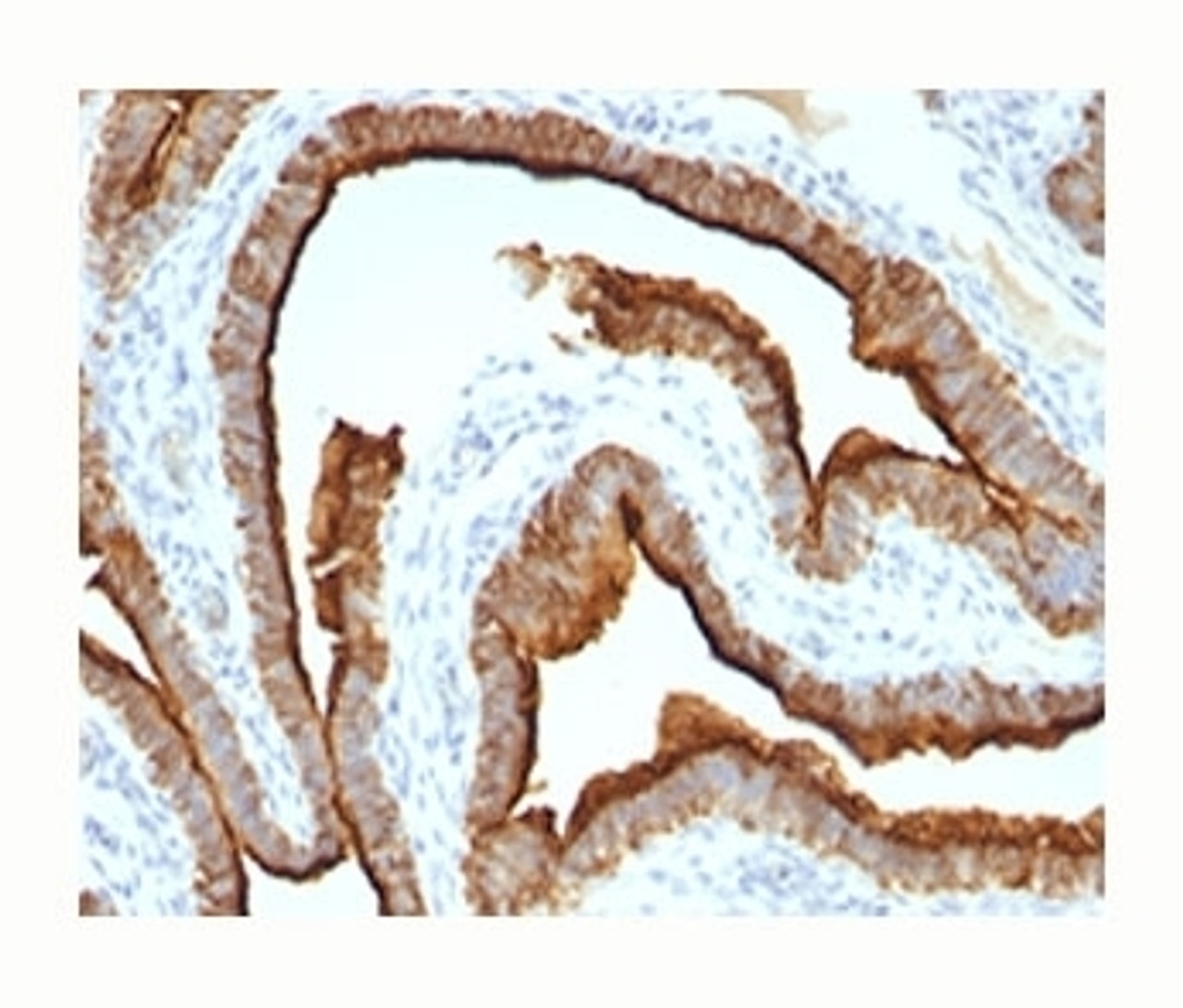 Epithelial Marker Antigen antibody IHC testing of formalin-paraffin human ovarian cancer tissue.