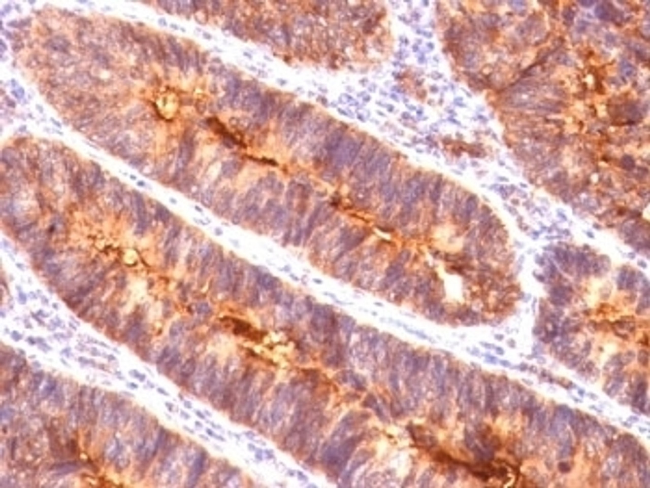 Formalin-fixed, paraffin-embedded human colon carcinoma stained with EMA antibody (MUC1/845) .