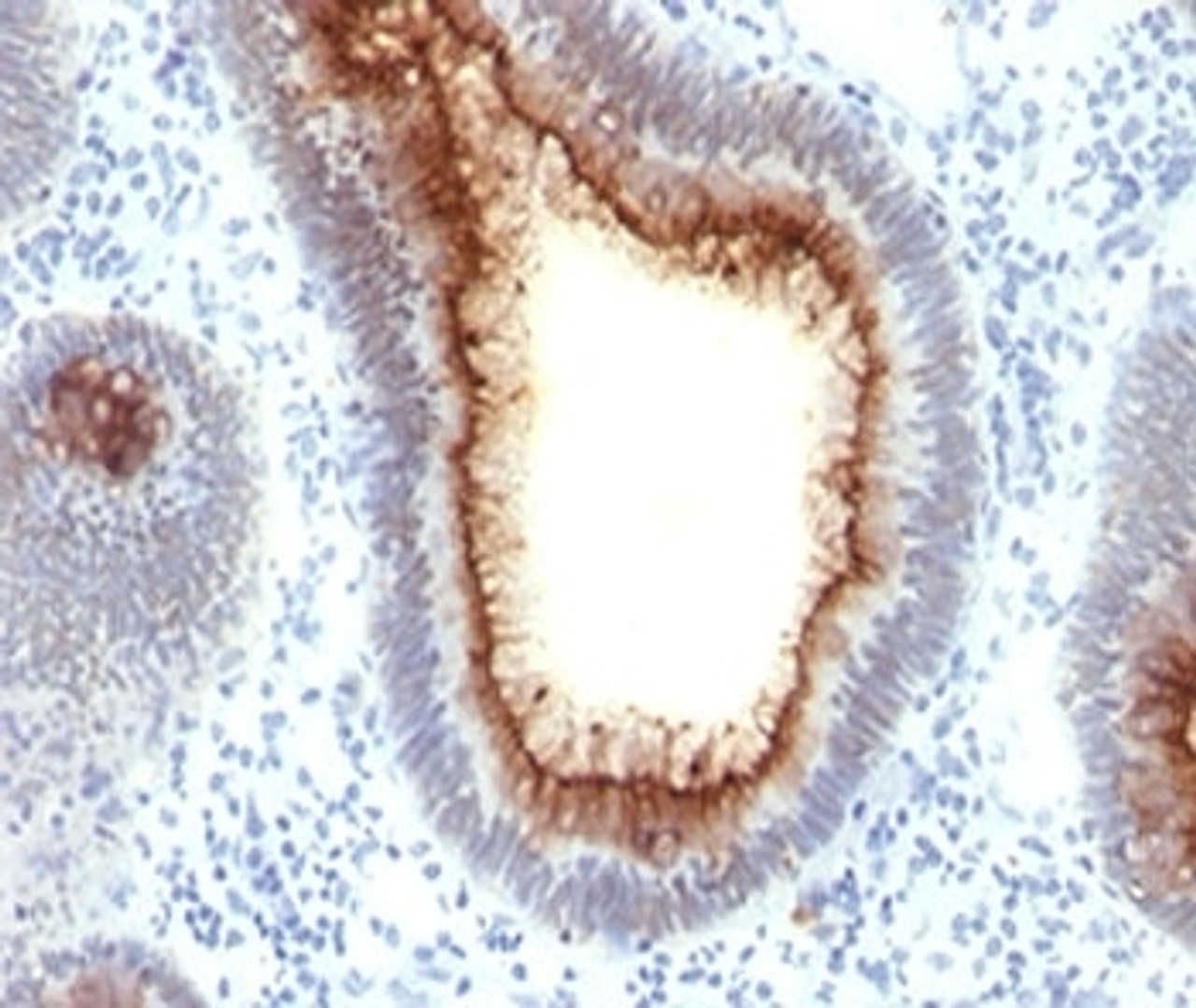 FFPE staining of human colon carcinoma with CEA antibody C66/1009.