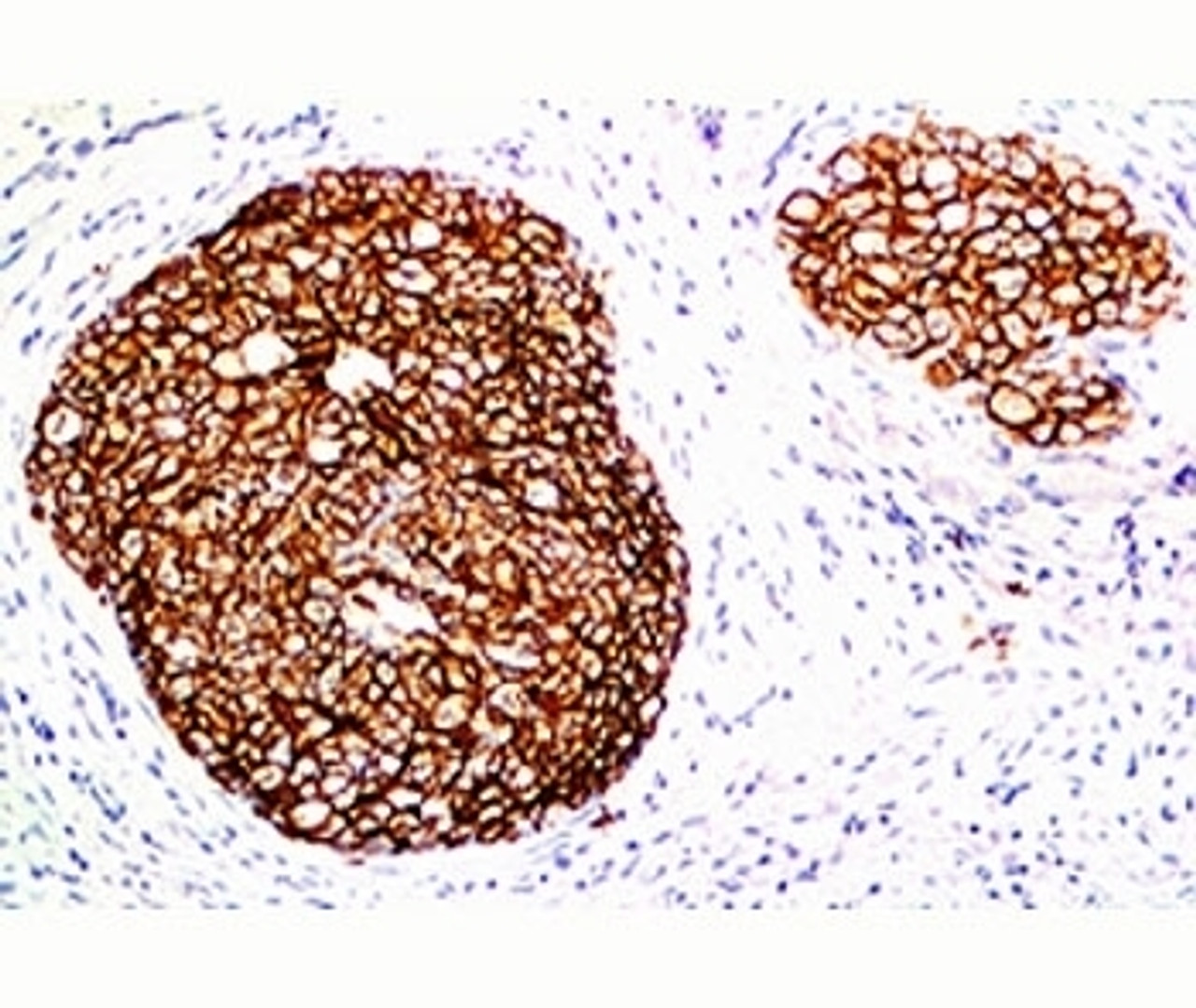 FFPE staining of human breast carcinoma with HER-2 antibody (ERB2/776) .