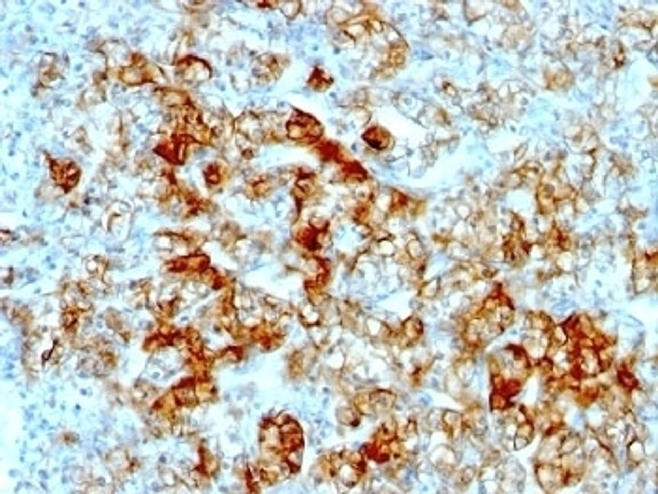 Formalin-fixed, paraffin-embedded human renal cell carcinoma stained with anti-Cadherin 16 antibody (SPM594)