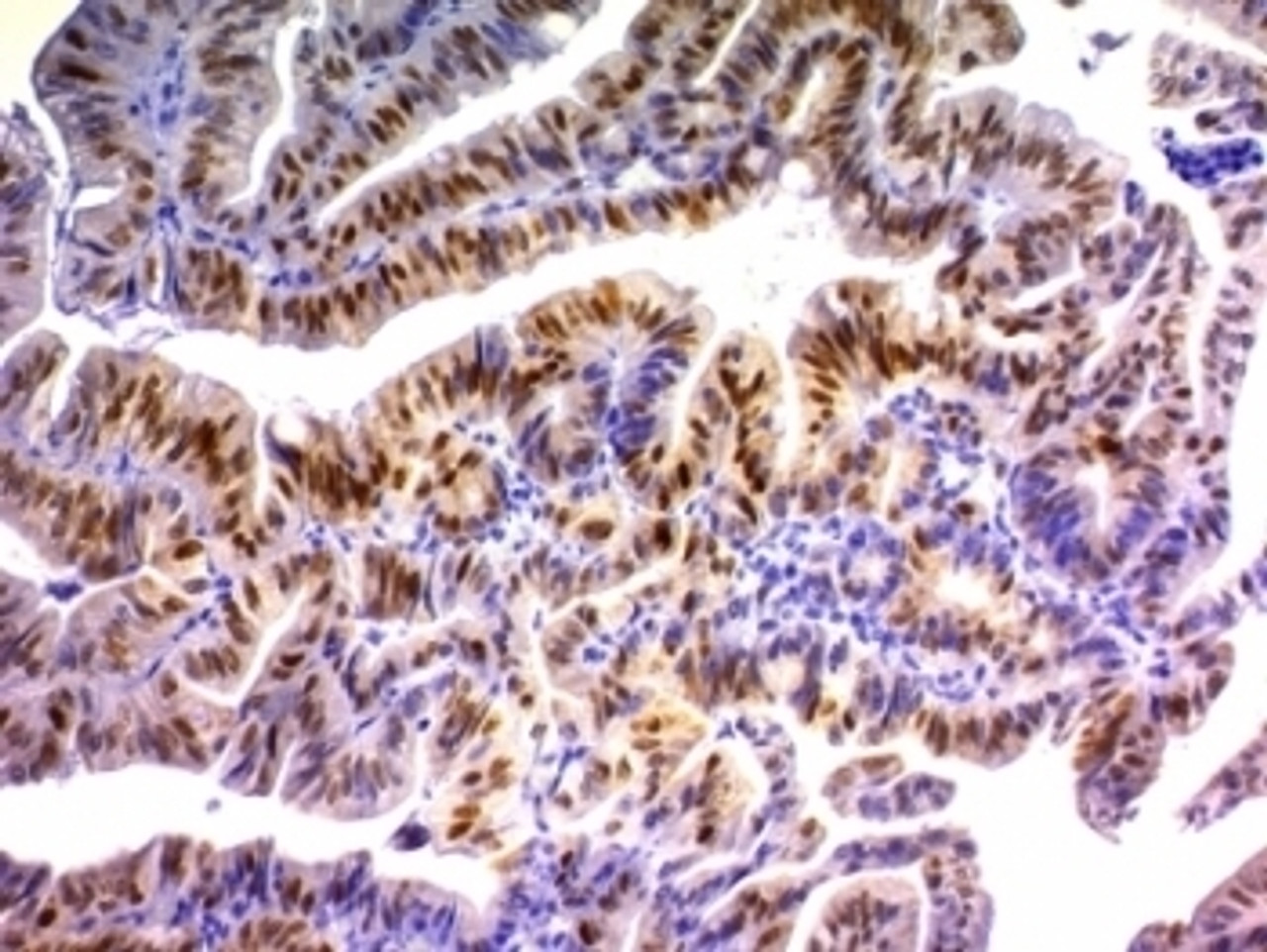 Formalin-fixed, paraffin-embedded human colon carcinoma stained with p21 antibody (DCS-60.2) .