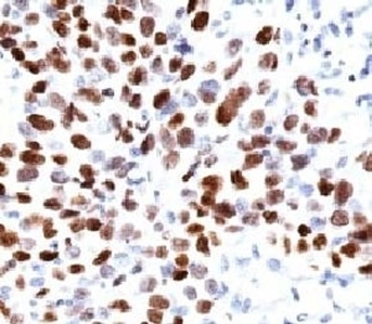 Formalin-fixed, paraffin-embedded human lung squamous cell carcinoma (SCC) stained with p21 antibody (CIP1/823) .