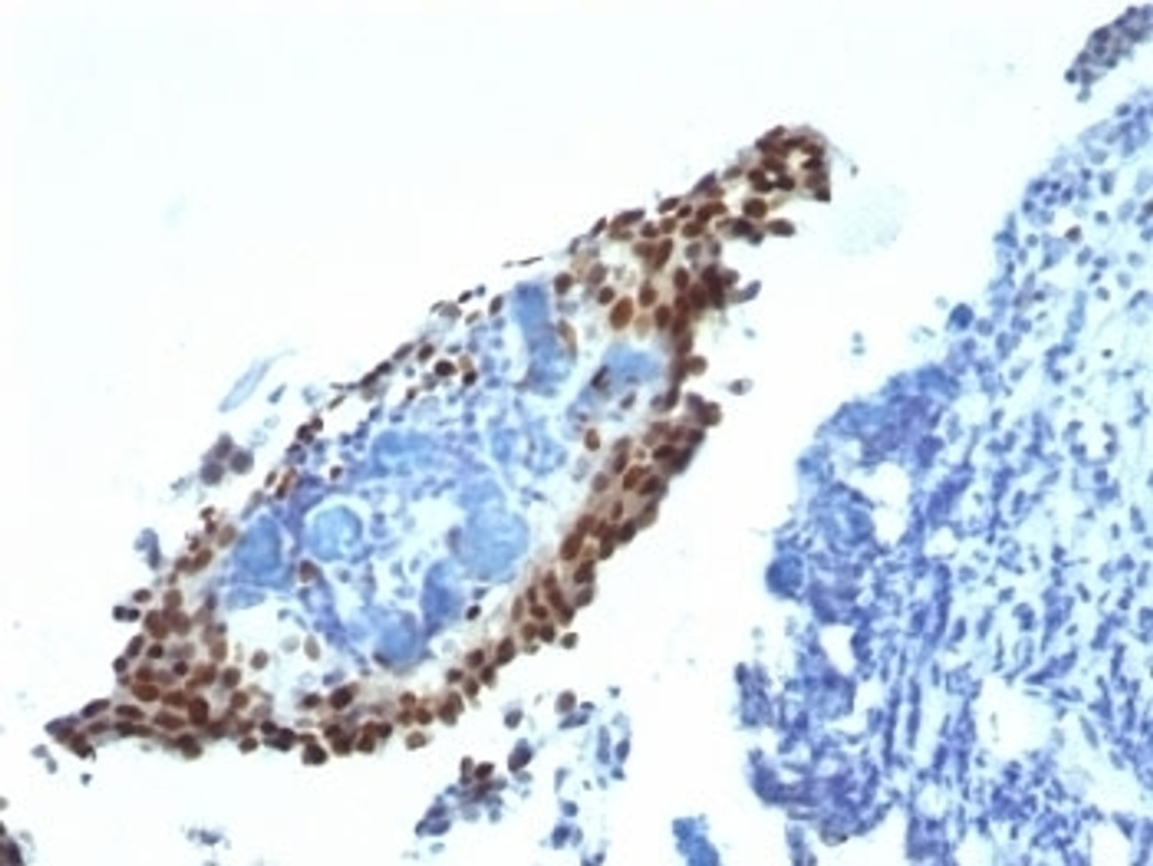 Formalin-fixed, paraffin-embedded bladder carcinoma stained with p21 antibody (HJ21) .