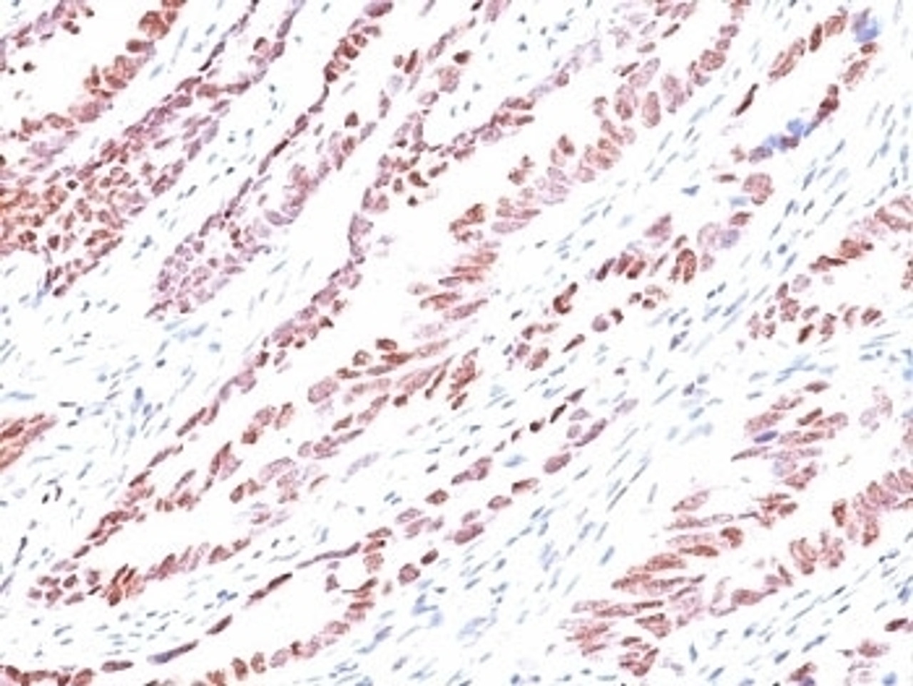 Formalin-fixed, paraffin-embedded human colon carcinoma stained with p57 antibody (KP10) .