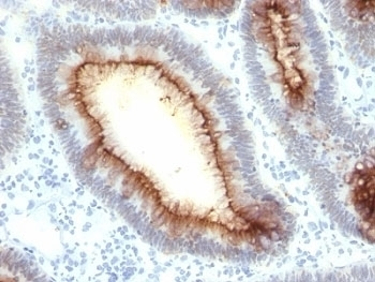 Formalin-fixed, paraffin-embedded human colon carcinoma stained with CEA antibody (SPM330) .