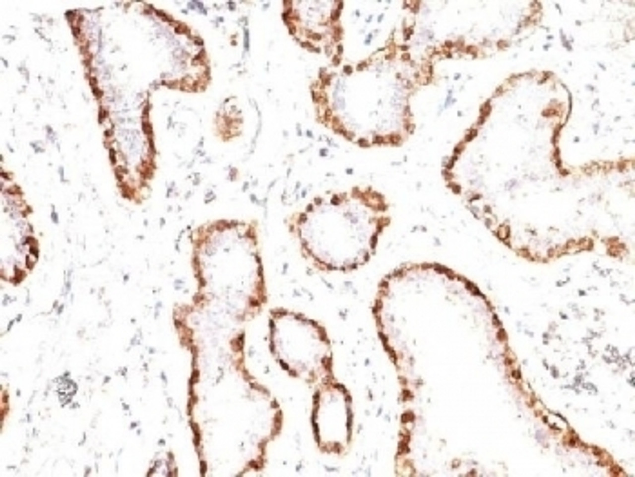 Formalin-fixed, paraffin-embedded human breast carcinoma stained with anti-Calponin antibody (CNN1/832) .