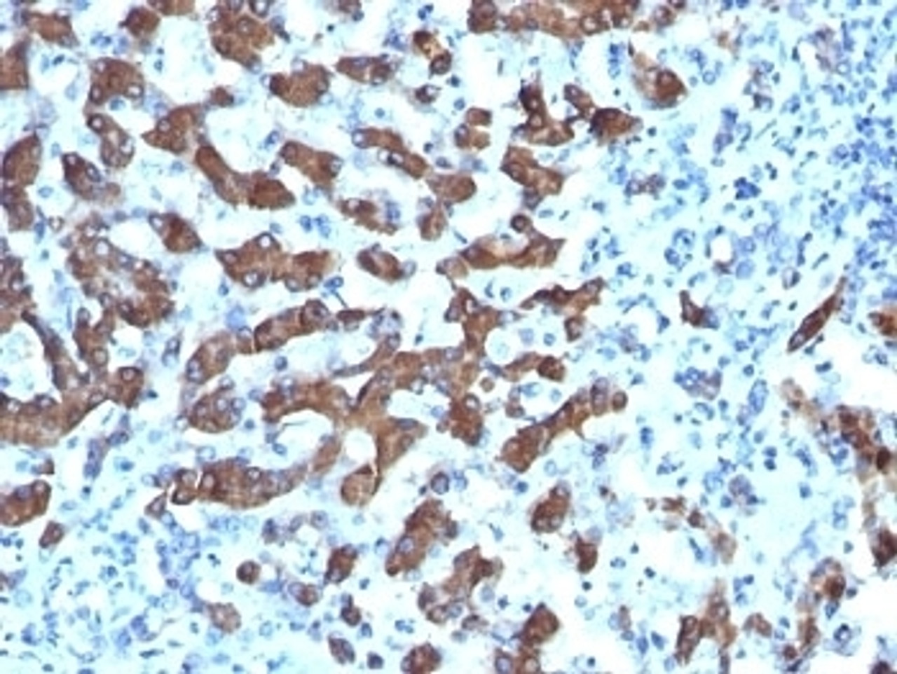 Formalin-fixed, paraffin-embedded human hepatocellular carcinoma stained with CPS1 antibody (CPS1/1022) .