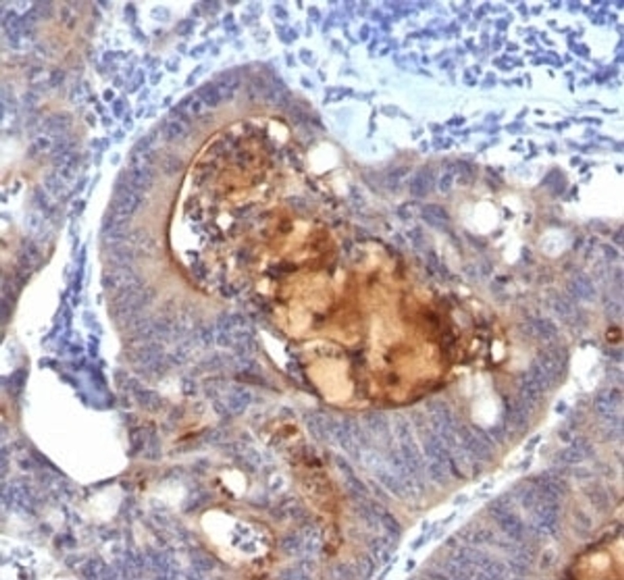 Formalin-fixed, paraffin-embedded human colon carcinoma stained with Secretory Component Glycoprotein antibody (ECM1/792) .