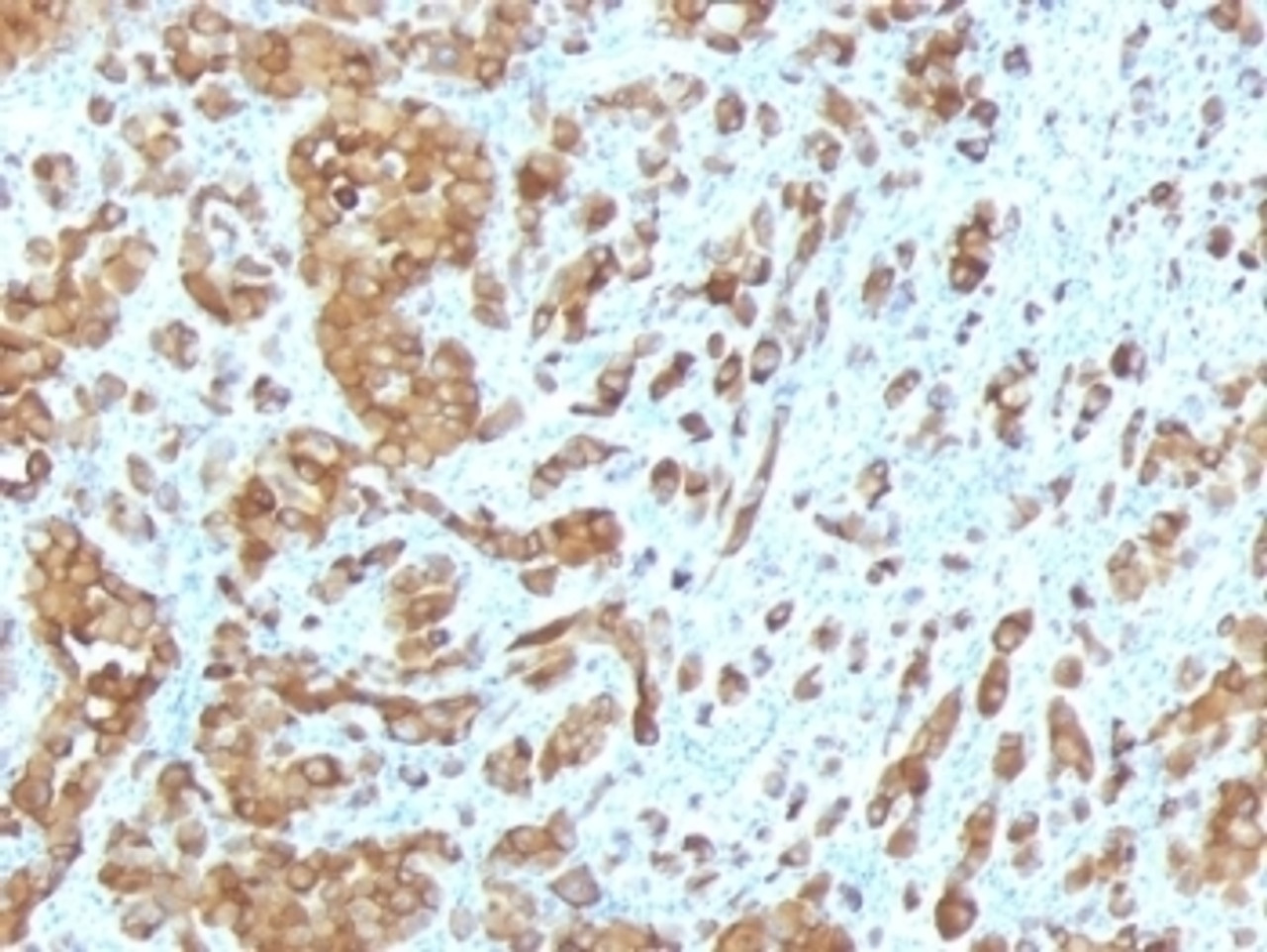 Formalin-fixed, paraffin-embedded human melanoma stained with Melan-A antibody (MLANA/788) .