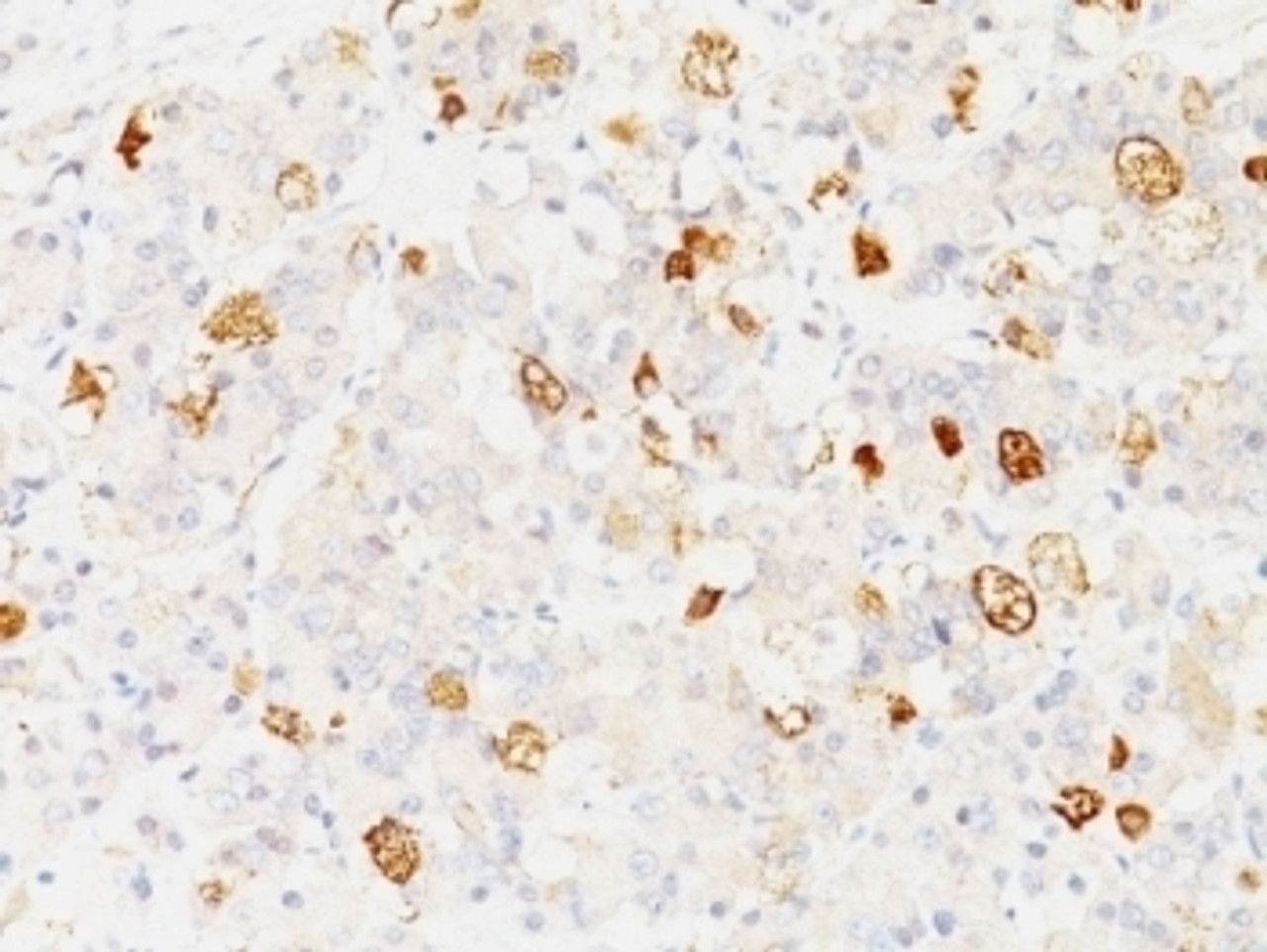 Formalin-fixed, paraffin-embedded human pituitary stained with FSH-beta antibody (SPM107) .