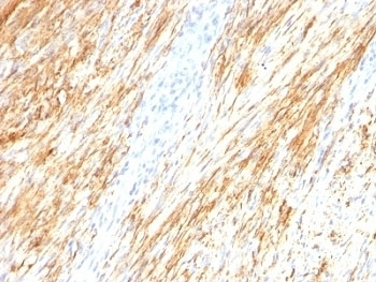 Formalin-fixed, paraffin-embedded human Schwanoma stained with GFAP antibody (ASTRO/789) .