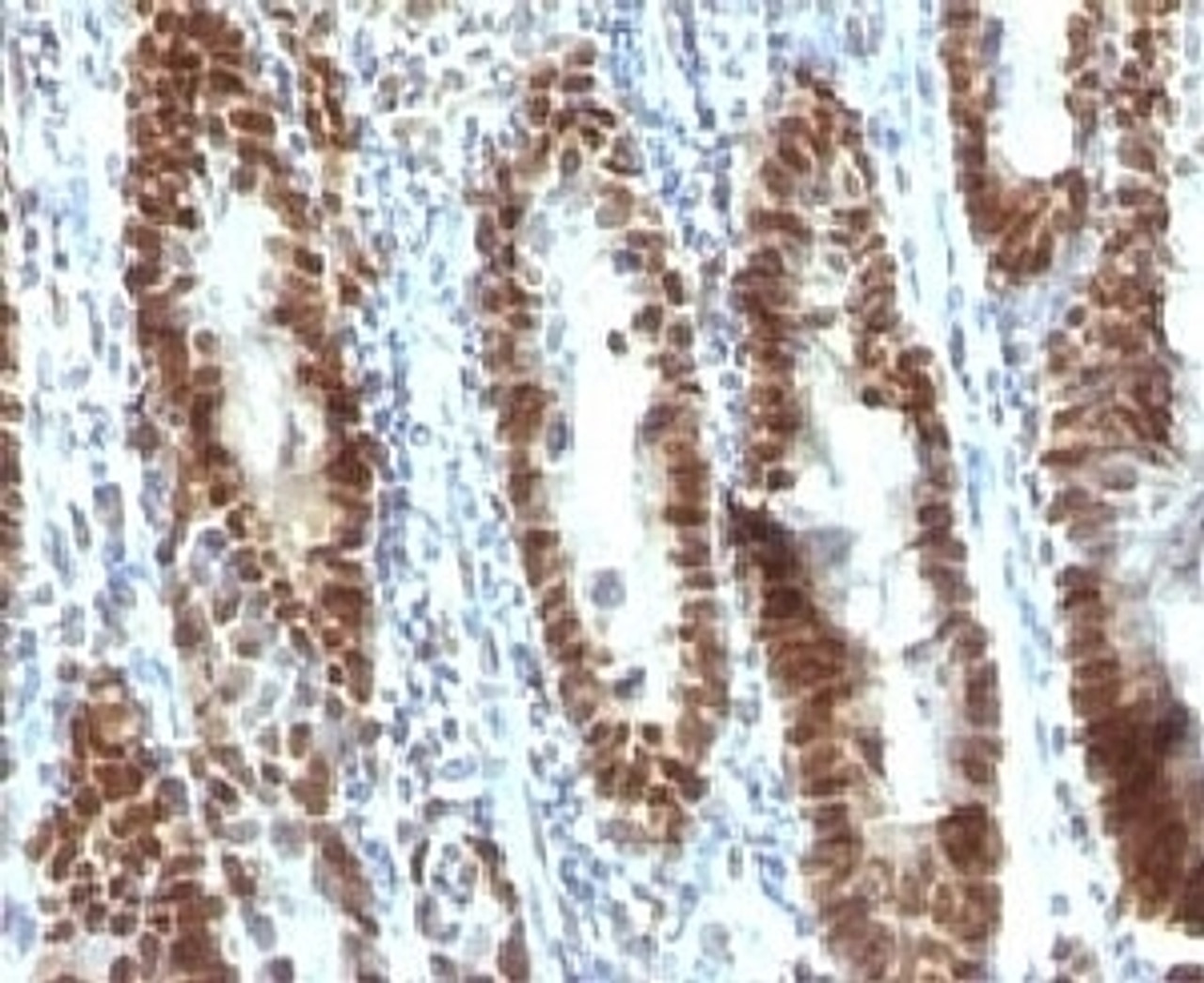 Formalin-fixed, paraffin-embedded human gastric carcinoma stained with TOX3 antibody (TOX3/1123) .