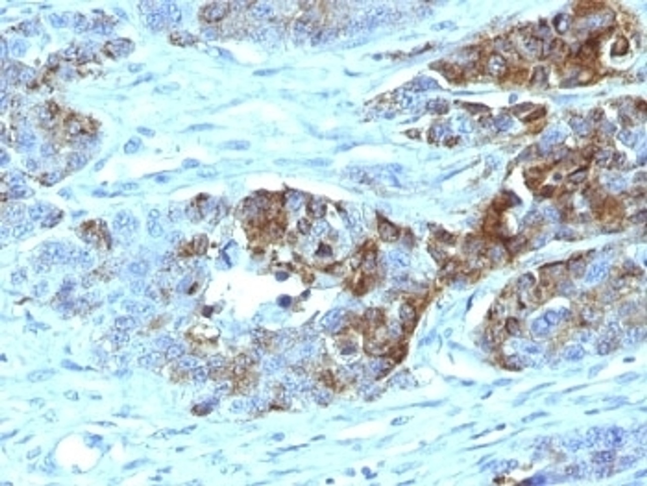 Formalin-fixed, paraffin-embedded human colon carcinoma stained with Blood Group Antigen H Type 2 antibody (19-OLE)